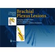 Brachial Plexus Lesions : Drawings of Explorations and Reconstructions by Algimantas Otonas Narakas,9783540634287 Brachial Plexus Lesions : Drawings of Explorations and Reconstructions by Algimantas Otonas Narakas,9783540634287