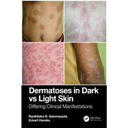 Dermatoses in Dark Vs Light Skin,9781040305157 Dermatoses in Dark Vs Light Skin,9781040305157