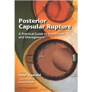 Posterior Capsular Rupture A Practical Guide to Prevention and Management