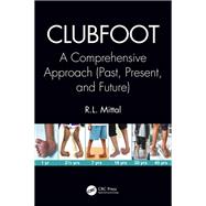 Clubfoot