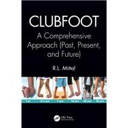 Clubfoot