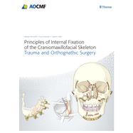 Principles of Internal Fixation of the Craniomaxillofacial Skeleton
