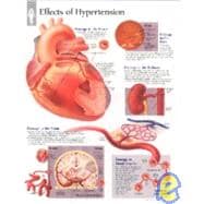 Effects of Hypertension chart Laminated Wall Chart
