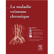 La maladie veineuse chronique