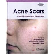 Acne Scars: Classification and Treatment