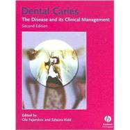 Dental Caries : The Disease and Its Clinical Management