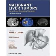 Malignant Liver Tumors Current and Emerging Therapies